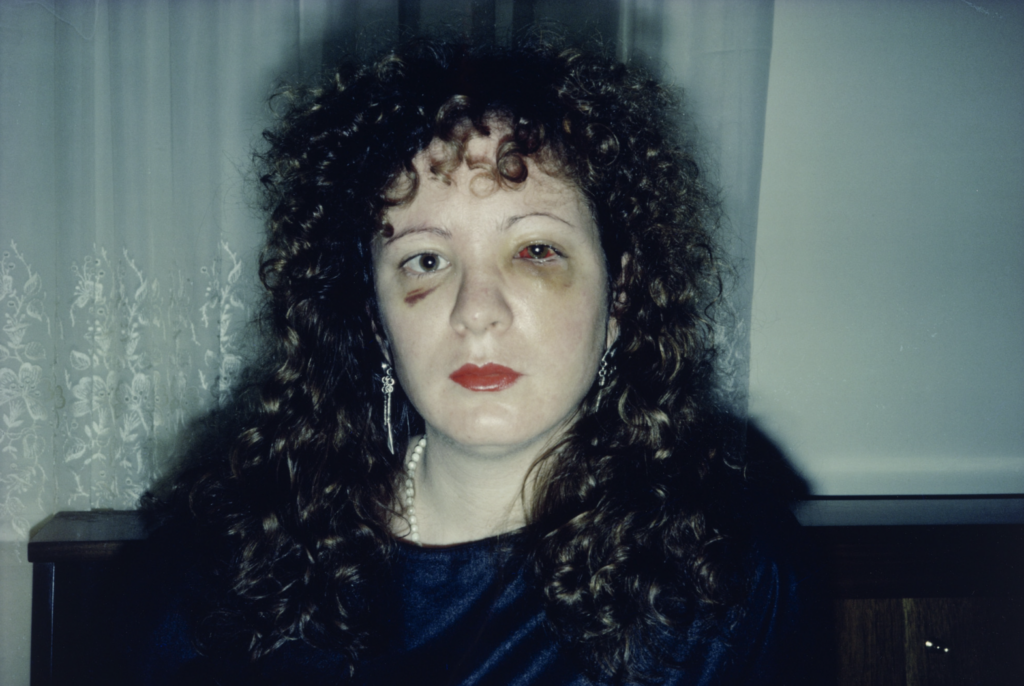 Nan Goldin, autoportrét s modrinami na tvári po fyzickom napadnutí, fotografia Nan One Month After Being Battered, 1984